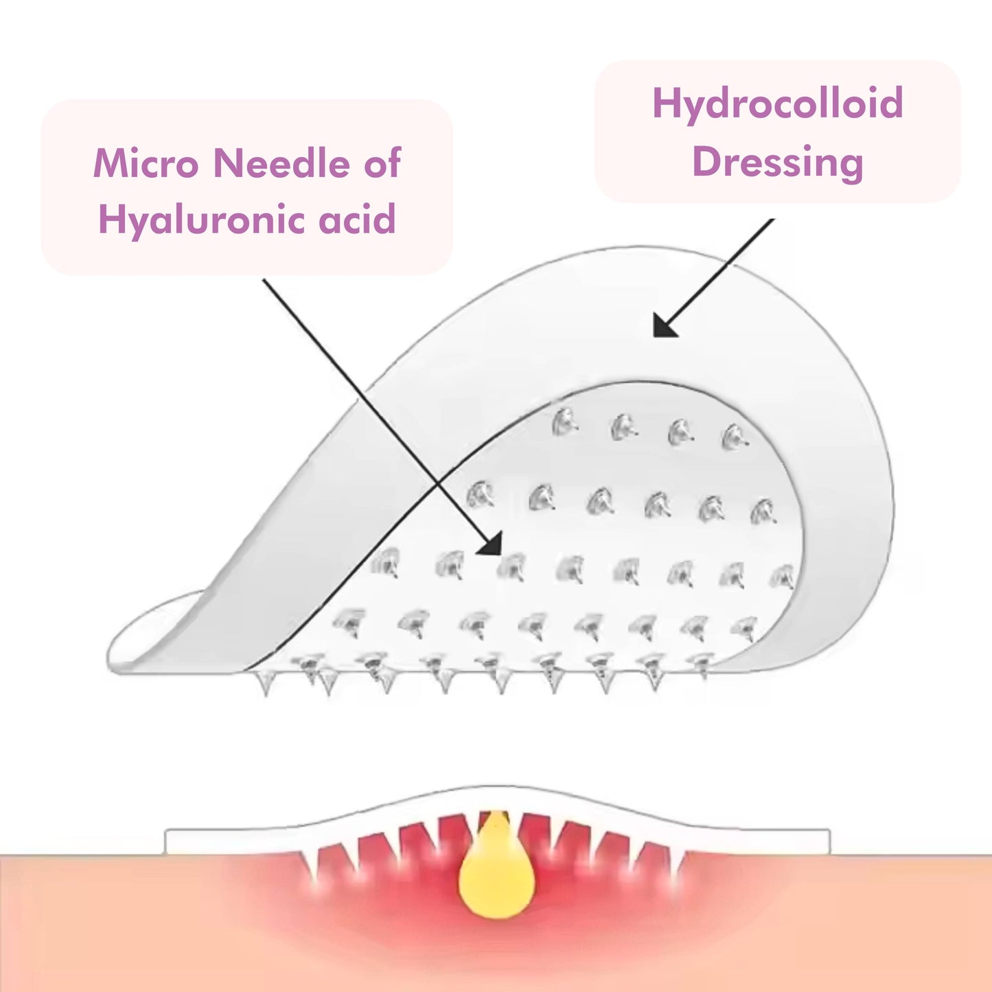 Microneedle Pimple Patches [9 Pcs] – Fast & Effective Acne
